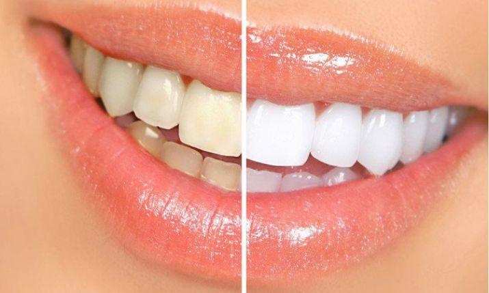 White Teeth : दांतों का पीलापन हटाने के लिए सेब साइडर सिरका का इस तरह करे इस्तेमाल
