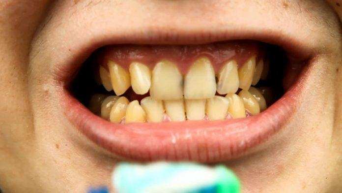 White Teeth : दांतों का पीलापन हटाने के लिए सेब साइडर सिरका का इस तरह करे इस्तेमाल