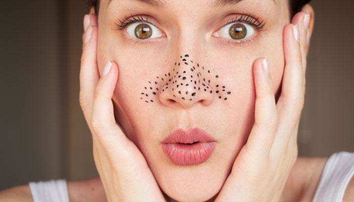 Pimples Tips : ब्लैकहेड्स से छुटकारा पाने के लिए इन टिप्स को आजमाएं