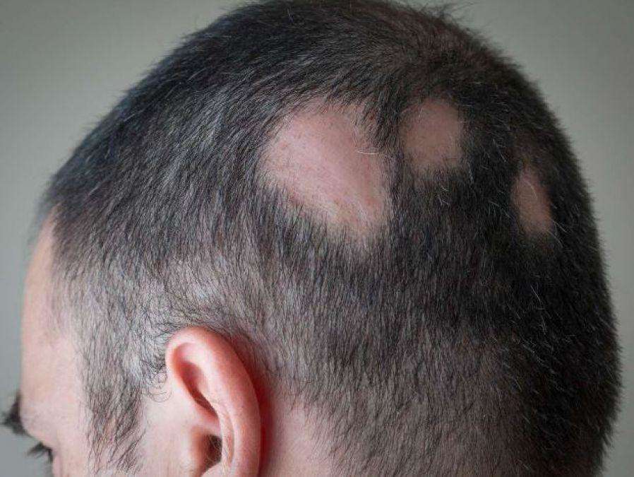 क्या आपके भी सिर से बाल गायब हो रहे हैं? जानें इसके कारण और उपाय