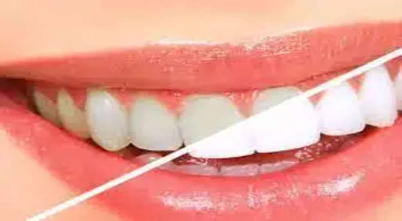 सिर्फ 5 मिनट Try करें ये Tips, सफेद मोती की तरह Shine करने लगेंगे Yellow Dirty Teeth