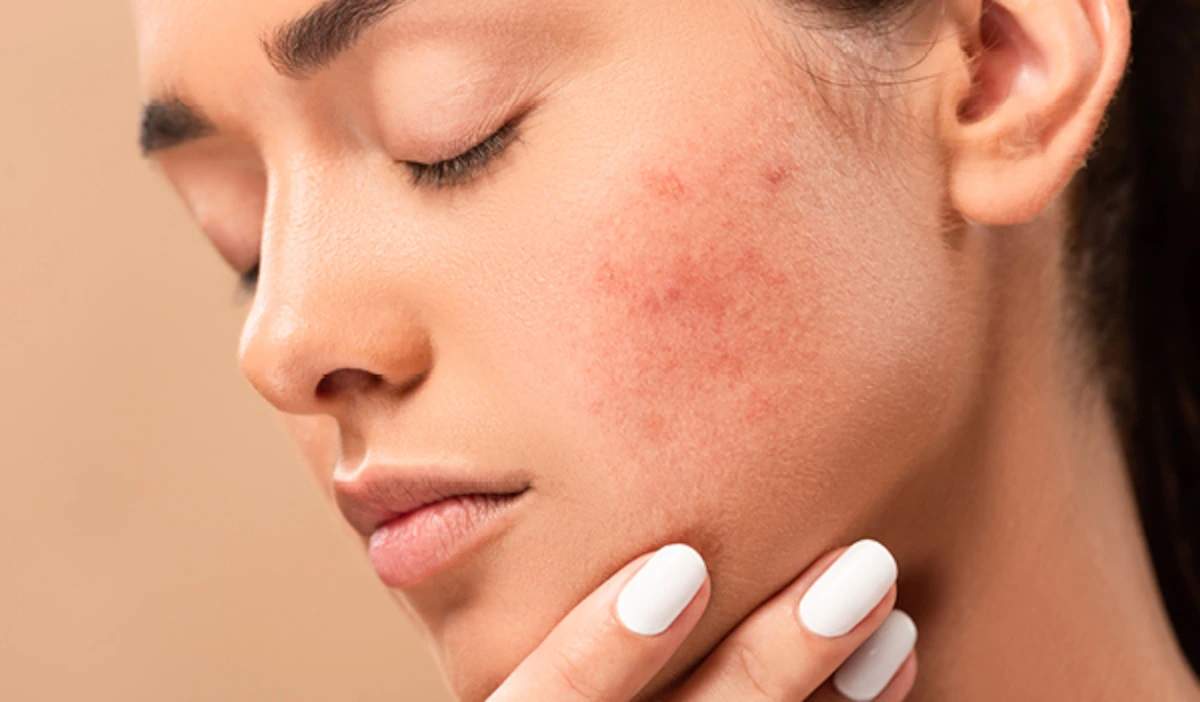 ये गलतियां बन सकती है Pimples और झुर्रियों का कारण, भूलकर भी ना करें ये काम