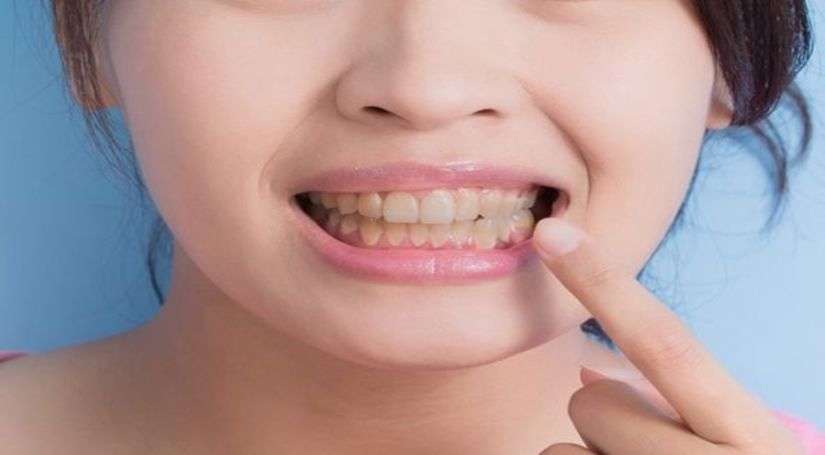 क्या आप भी Tooth plaque के कारण खुलकर मुस्कुराने में असमर्थ हैं ? जानिए कारण और घरेलू उपचार !