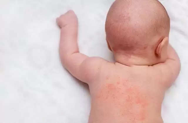 आपने शिशुओं की त्वचा पर लालिमा या लाल धब्बे देखे होंगे। कई बार हम इसे एलर्जी समझकर नजरअंदाज कर देते हैं, अगर ये रैशेज बच्चे के शरीर में ज्यादा समय तक रहें तो इससे एक्जिमा भी हो सकता है। इन लाल धब्बों को छूने और खरोंचने से ये शरीर के अन्य हिस्सों में फैल सकते हैं और त्वचा संबंधी कई अन्य समस्याएं पैदा कर सकते हैं।  सावधान रहने की जरूरत यह त्वचा की अतिसंवेदनशीलता के कारण होता है, यदि बच्चे को जन्म के दो से तीन महीने के भीतर यह रोग हो जाता है, तो यह अक्सर वंशानुगत होता है। अगर परिवार के अन्य सदस्यों को एक्जिमा, अस्थमा या हे फीवर जैसी बीमारियां हैं, तो बच्चे को भी ये रोग हो सकते हैं। एक्जिमा न केवल शारीरिक बल्कि मानसिक स्वास्थ्य को भी प्रभावित करता है। एक्जिमा आमतौर पर कोहनी, जांघों, घुटनों, पीठ, पेट, हाथों और कानों के आसपास होता है। अगर समय रहते इस पर काबू नहीं पाया गया तो यह गंभीर रूप भी ले सकता है। आइए जानते हैं इसके कारण और इलाज।  लक्षण कोहनी और कान के पीछे की त्वचा शुष्क और लाल हो जाती है।  त्वचा का फटना और दर्द।  लाल क्षेत्र में जल रहा है  संक्रमण की जगह पर तेज खुजली  द रीज़न गाय के दूध से एलर्जी एक कारण हो सकती है, क्योंकि इसका प्रमाण स्तनपान करने वाले शिशुओं की तुलना में बोतल से दूध पीने वाले शिशुओं में अधिक होता है। परेशान करने वाले डिटर्जेंट, साबुन, शैंपू या तेल त्वचा में जलन और एक्जिमा पैदा कर सकते हैं।  समाधान हालांकि, एक्जिमा को पूरी तरह से ठीक करने के लिए कोई उपचार विधि उपलब्ध नहीं है। लेकिन निम्नलिखित उपायों से रोग की गंभीरता को कम किया जा सकता है या टाला जा सकता है। यदि बच्चे को गाय का दूध पिलाया जाए तो उसे बंद कर देना चाहिए और उसे बकरी या भैंस का दूध या सोयाबीन का दूध पिलाना चाहिए। जैतून के तेल को गर्म करके मालिश करने से भी लाभ होता है। अधिक दर्द होने पर डॉक्टर की सलाह के बाद औषधि युक्त मलहम का प्रयोग किया जा सकता है। इसी तरह, बच्चे को रोगग्रस्त क्षेत्र को खरोंचने से रोकना चाहिए। इसके लिए उसके नाखूनों को नियमित रूप से काटें। रात को सोते समय हाथों को रूई से ढकने से भी मदद मिलती है, नींद की हल्की गोलियों का भी इस्तेमाल किया जा सकता है।