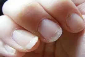 Corona काल में में अगर Nails से उखड़ने लगे Skin, तो हो सकता है Omicron का खतरा करें ये Home Remedies